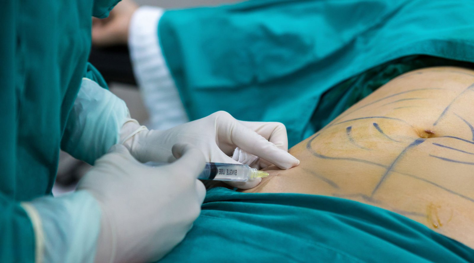 Local anesthesia,Body Liposculpture Procedure.