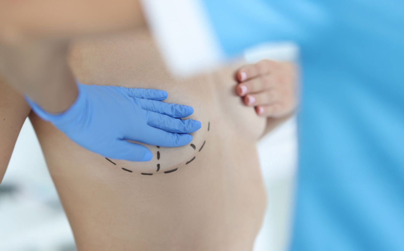 Closeup of body of naked sexy woman with black surgical marks on chest. Plastic surgery breast augmentation and lift concept